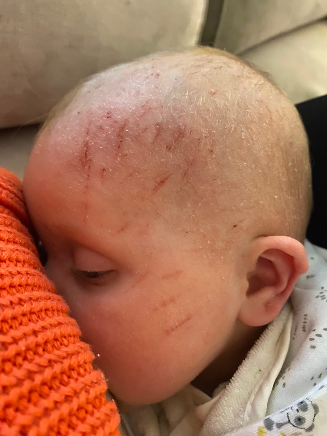 Customer photo review of Bioskin Junior Outbreak Rescue Cream