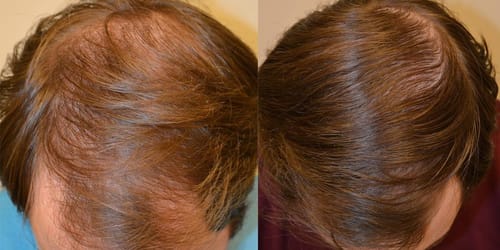 Customer photo review of Root Activator Shampoo™ - Sale