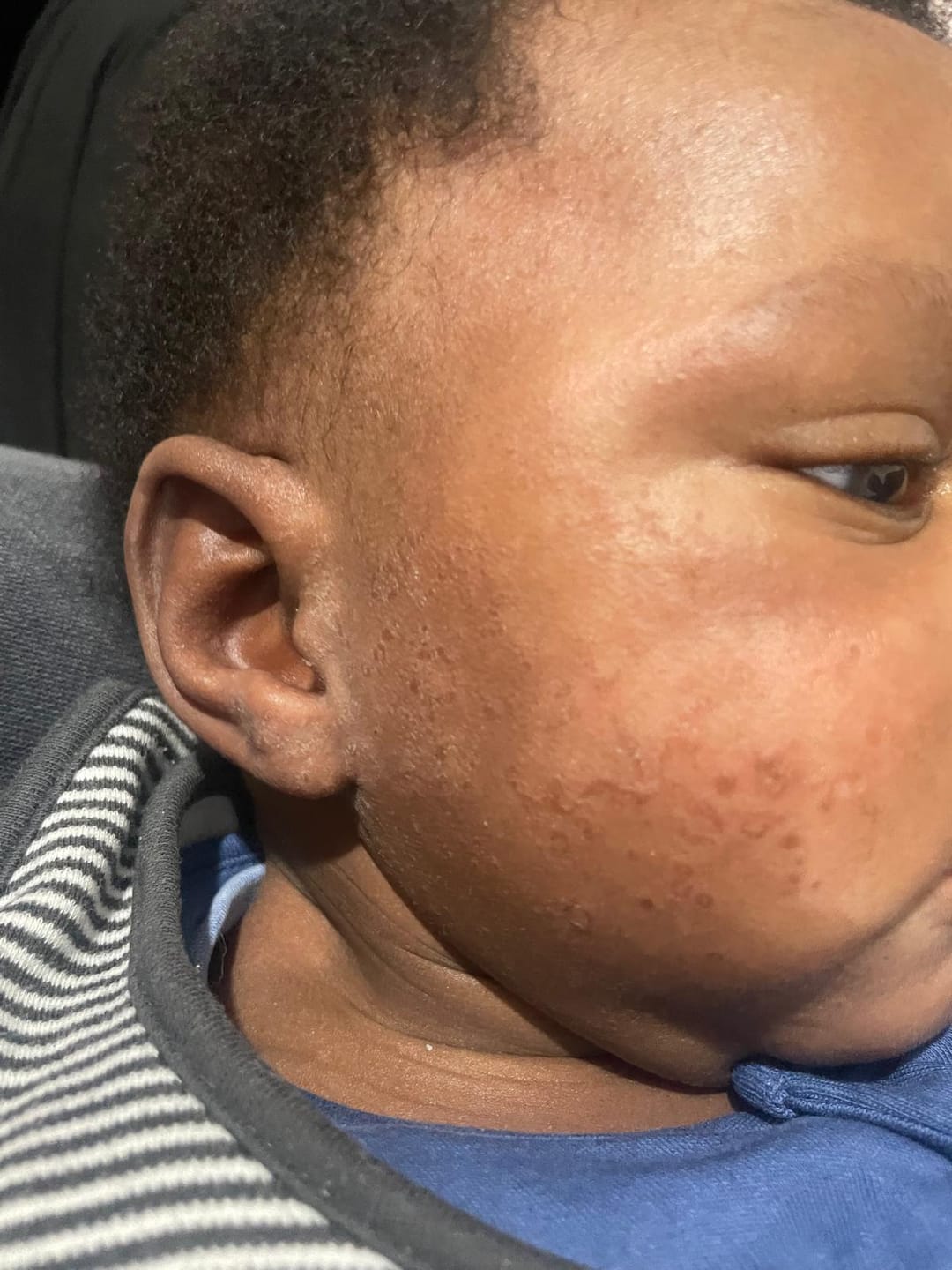Customer photo review of Bioskin Junior Outbreak Rescue Cream