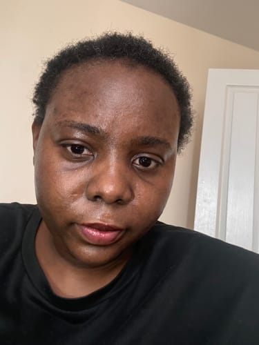 Customer photo review of Anti-Acne & Dark Spots African Soap