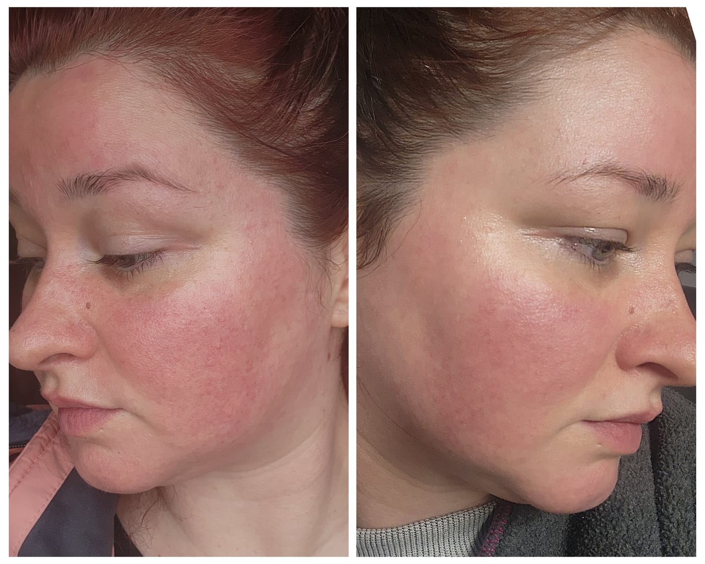 Customer photo review of Instant Rosacea, Acne & Redness Stopper