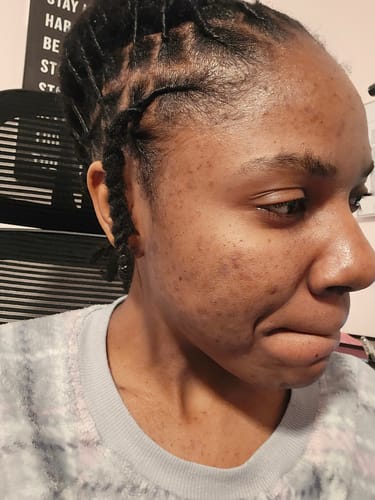 Customer photo review of Tea Tree Daily Face Wash/Cleanser