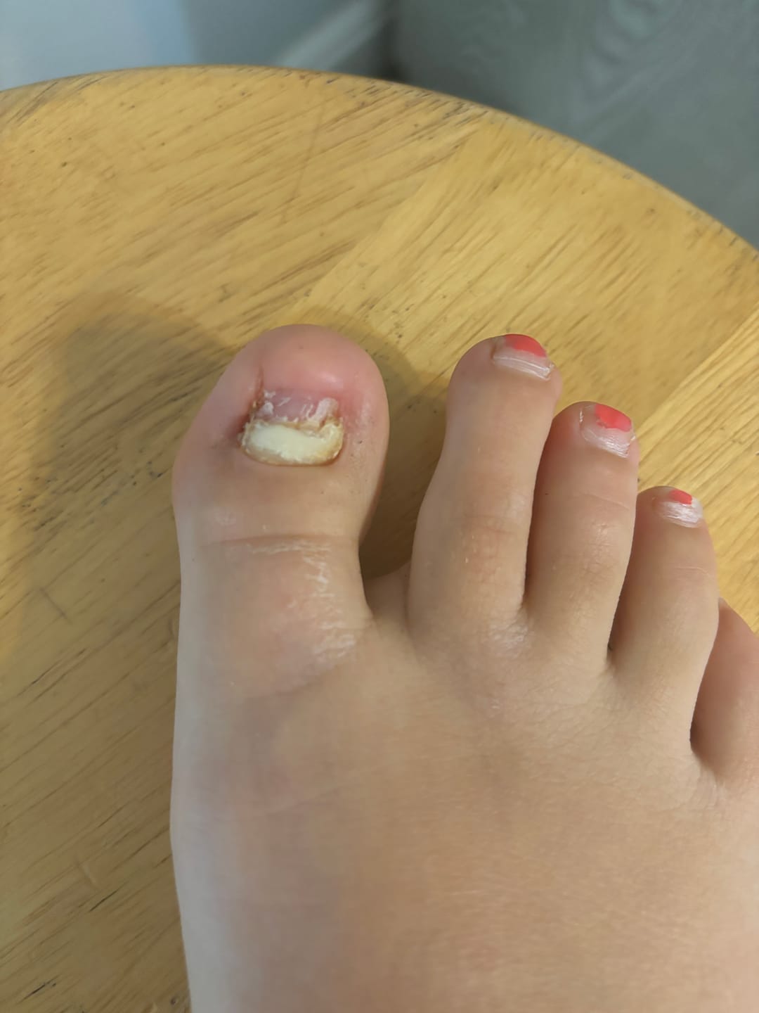 Customer photo review of Onychom Pro Antifungal LED Device