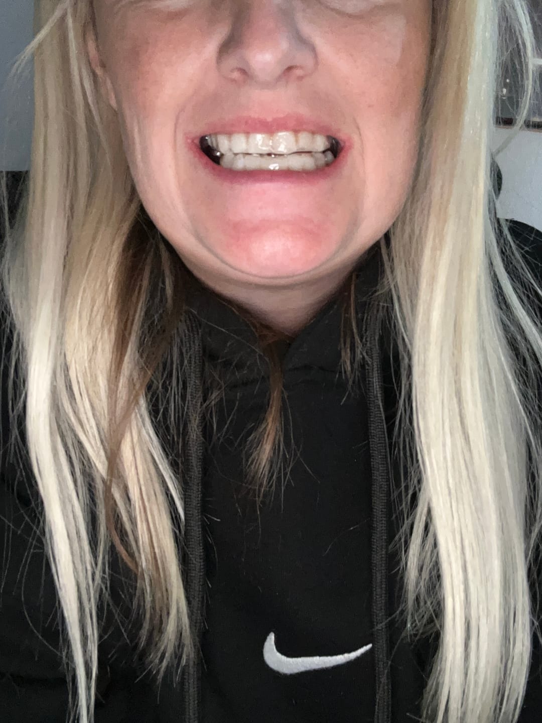 Customer photo review of Teeth Whitening Strips