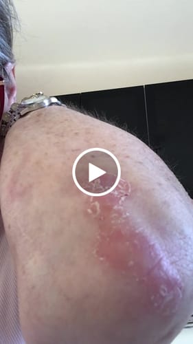 Customer video review of Sereni Pikkelysömör és Ekcéma Krém