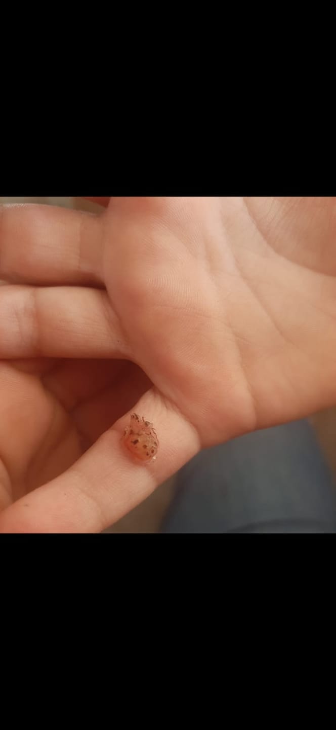 Customer photo review of The Wartabater | Electronic Wart Remover | Safe, Easy, & Effective
