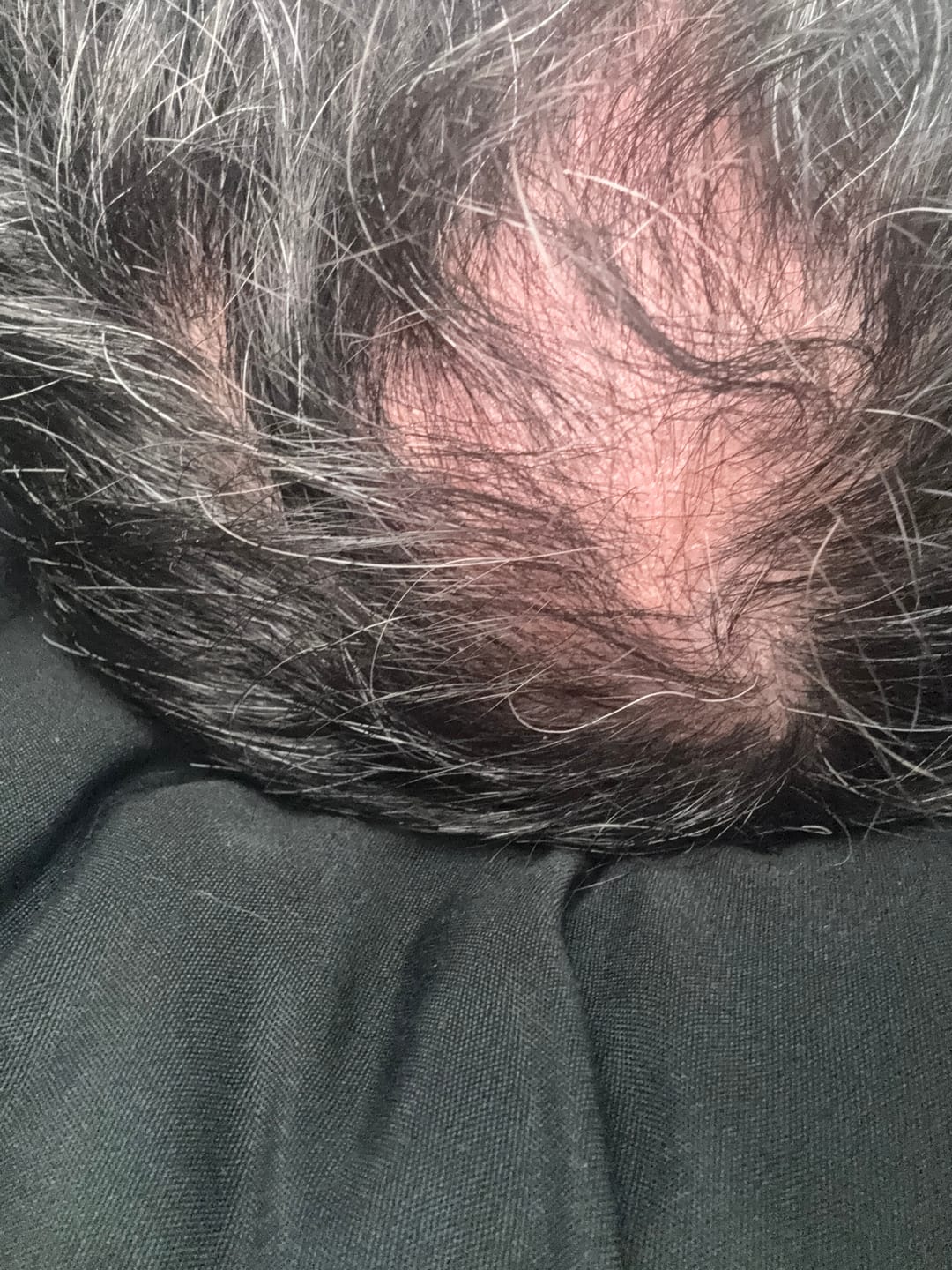 Customer photo review of Kit Adiós Alopecia