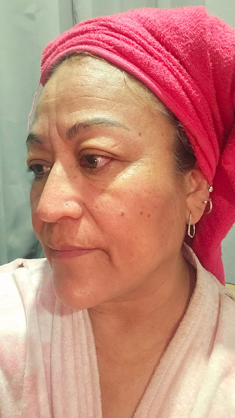 Customer photo review of NUEVO: Kit Los 4 Fantásticos (44% OFF) - Serum de Vitamina C 30ml + Serum de Niacinamida 30ml + Serum Ácido Glicólico 30ml + Serum de Ácido Hialurónico 30ml