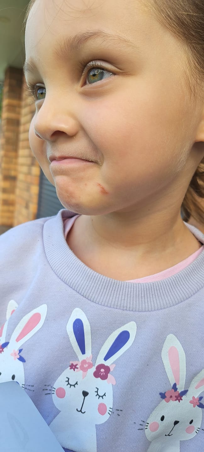 Customer photo review of DermaGen Propolis Balm - with Antiseptic, Anti-inflammatory, and Antioxidant Properties