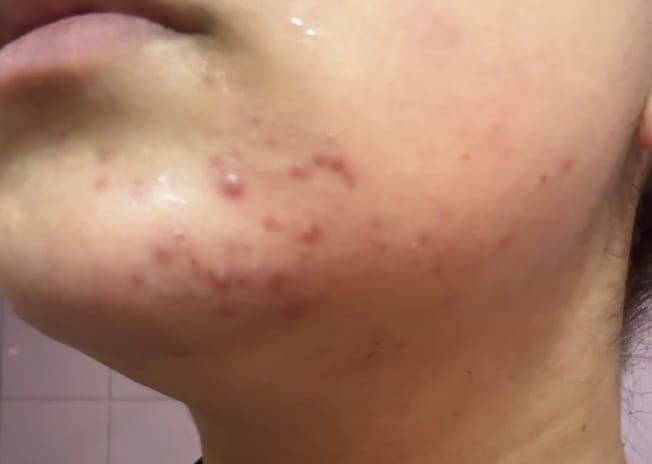 Customer photo review of Dr. Tisha AC7 Анти акне серум с микроигли (спикули)
