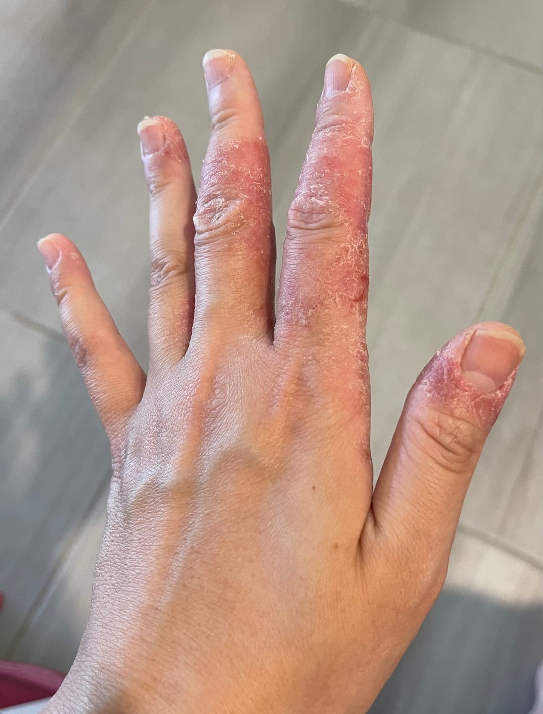 Customer photo review of DermaGen Manuka Balm - Your #1 Mulitpurpose Balm for the Family
