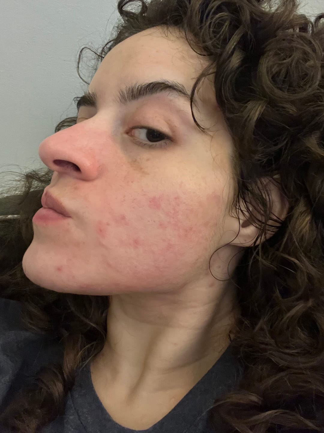 Customer photo review of The Complete Acne System for Women