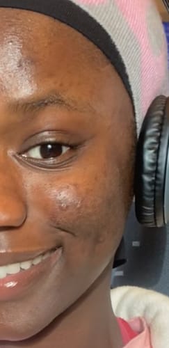 Customer photo review of Sérum acné contrôle