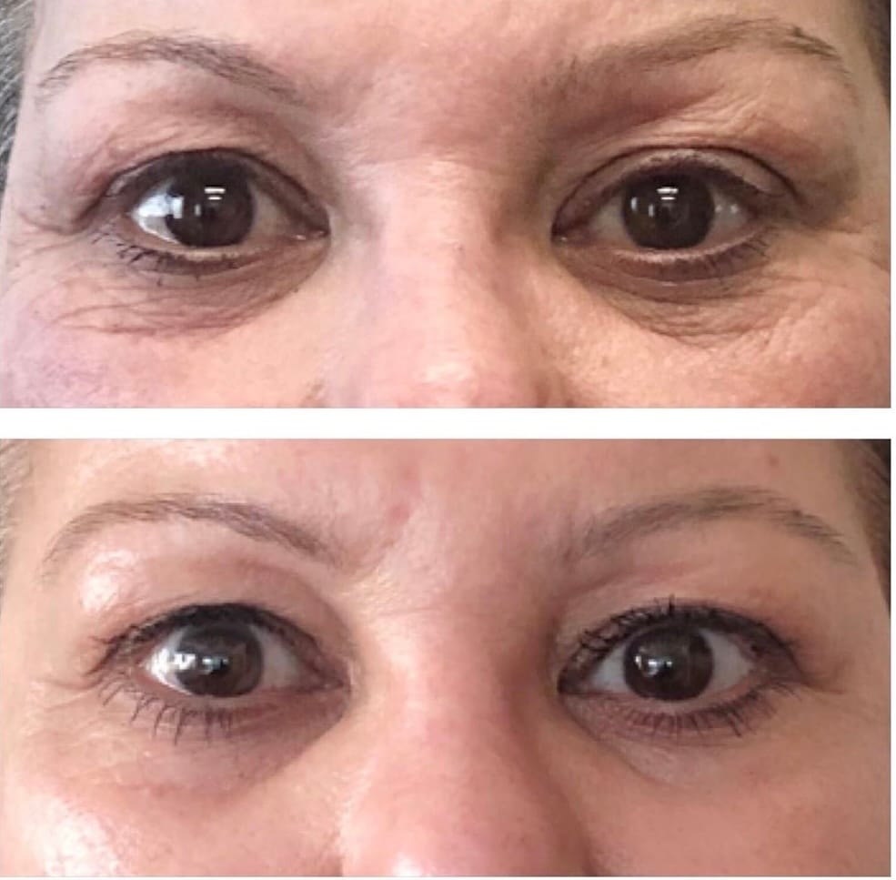 Customer photo review of Under Eye Skincare Wand