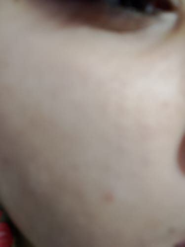 Customer photo review of BAKUCHIOL RESURFACING NIGHT SERUM - with 10% Lactic Acid