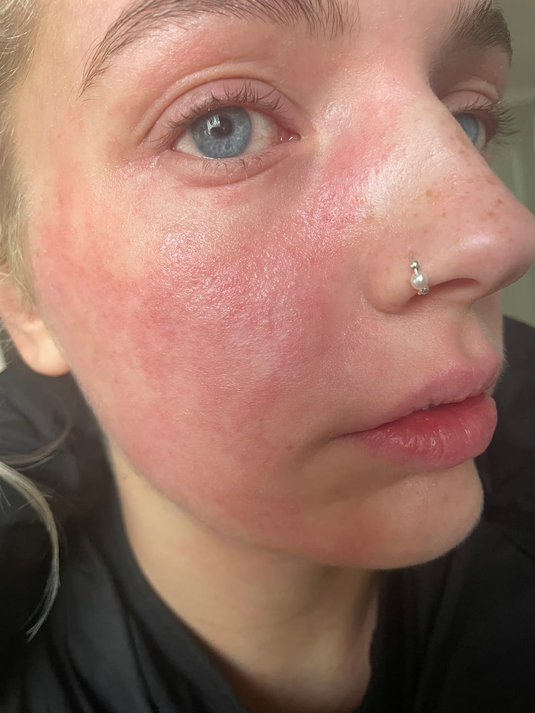 Customer photo review of Bioskin Junior Duo Pack (Free Outbreak Rescue Cream)