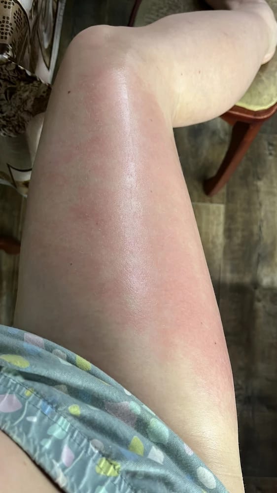 Customer photo review of GlowNow Cellulite-Massagegerät