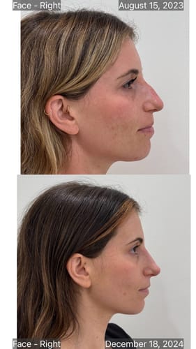 Customer photo review of NoseFix: Filler