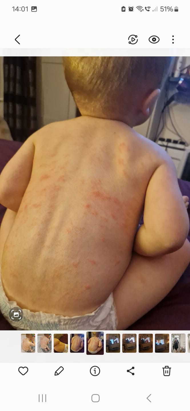 Customer photo review of Bioskin Junior Outbreak Rescue Cream