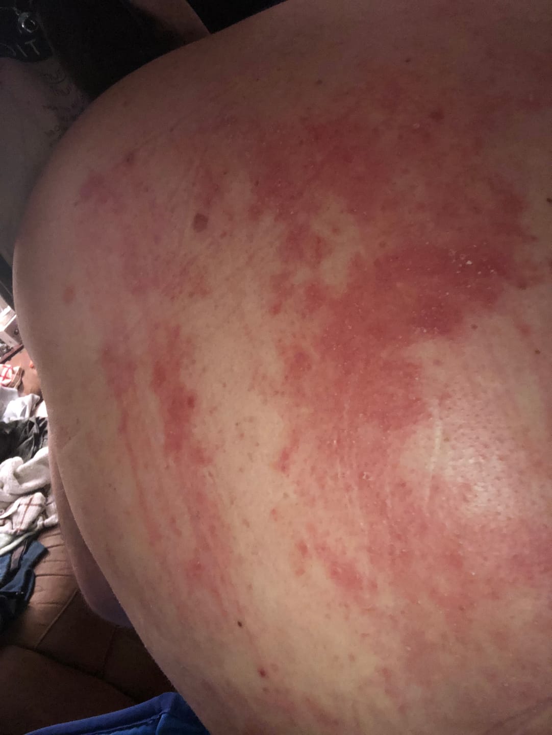Customer photo review of Bioskin DermaSpray Intensive