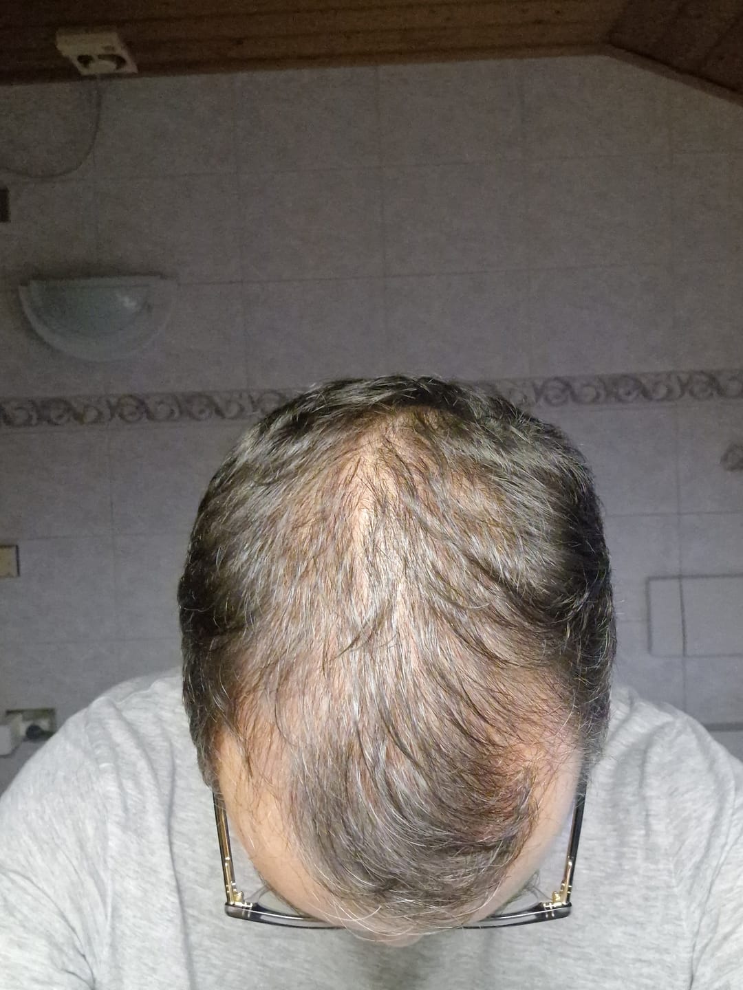 Customer photo review of Hair Density - Shampoo Anti Caduta