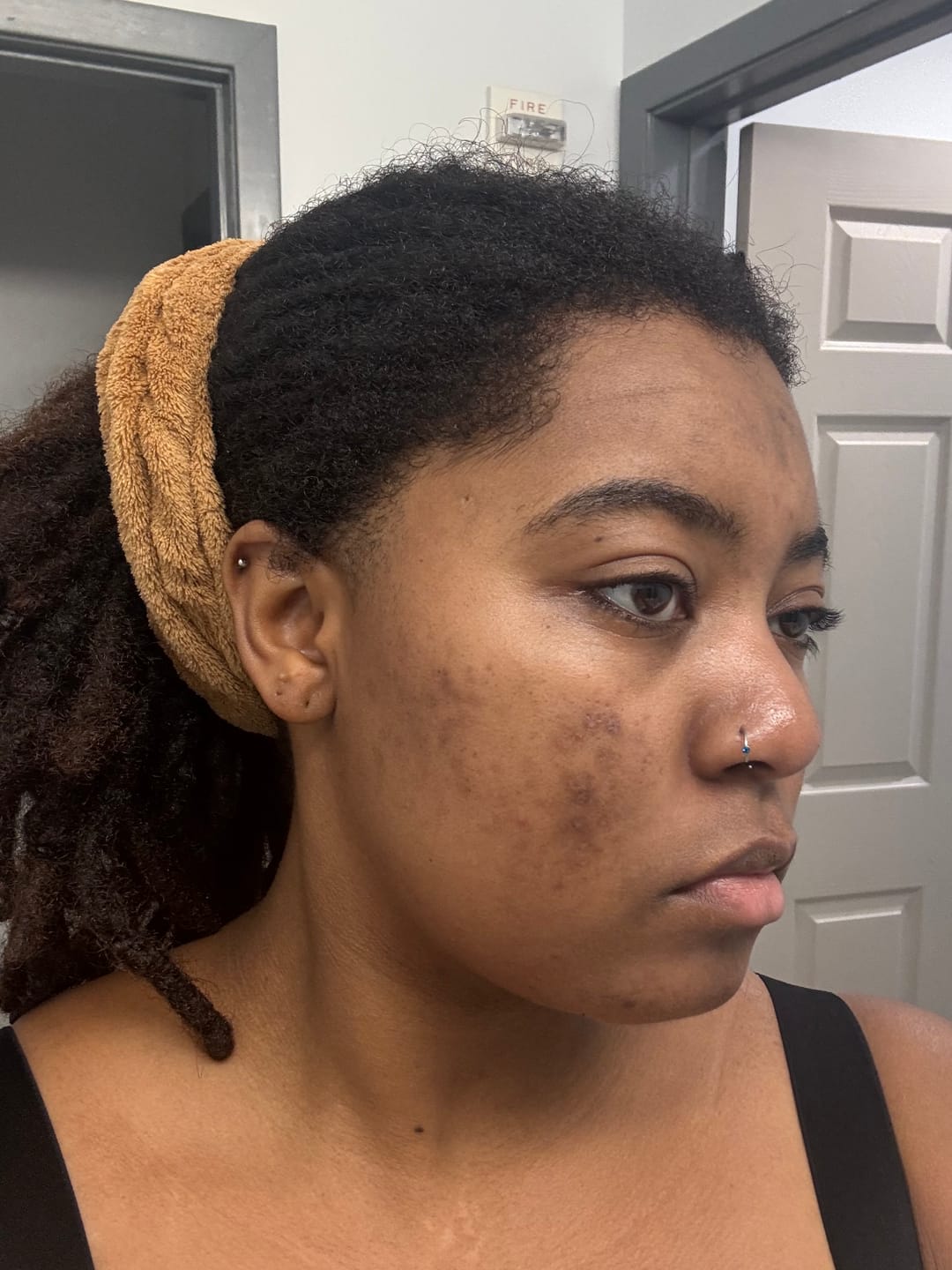 Customer photo review of Magic Eraser Dark Spot Cream