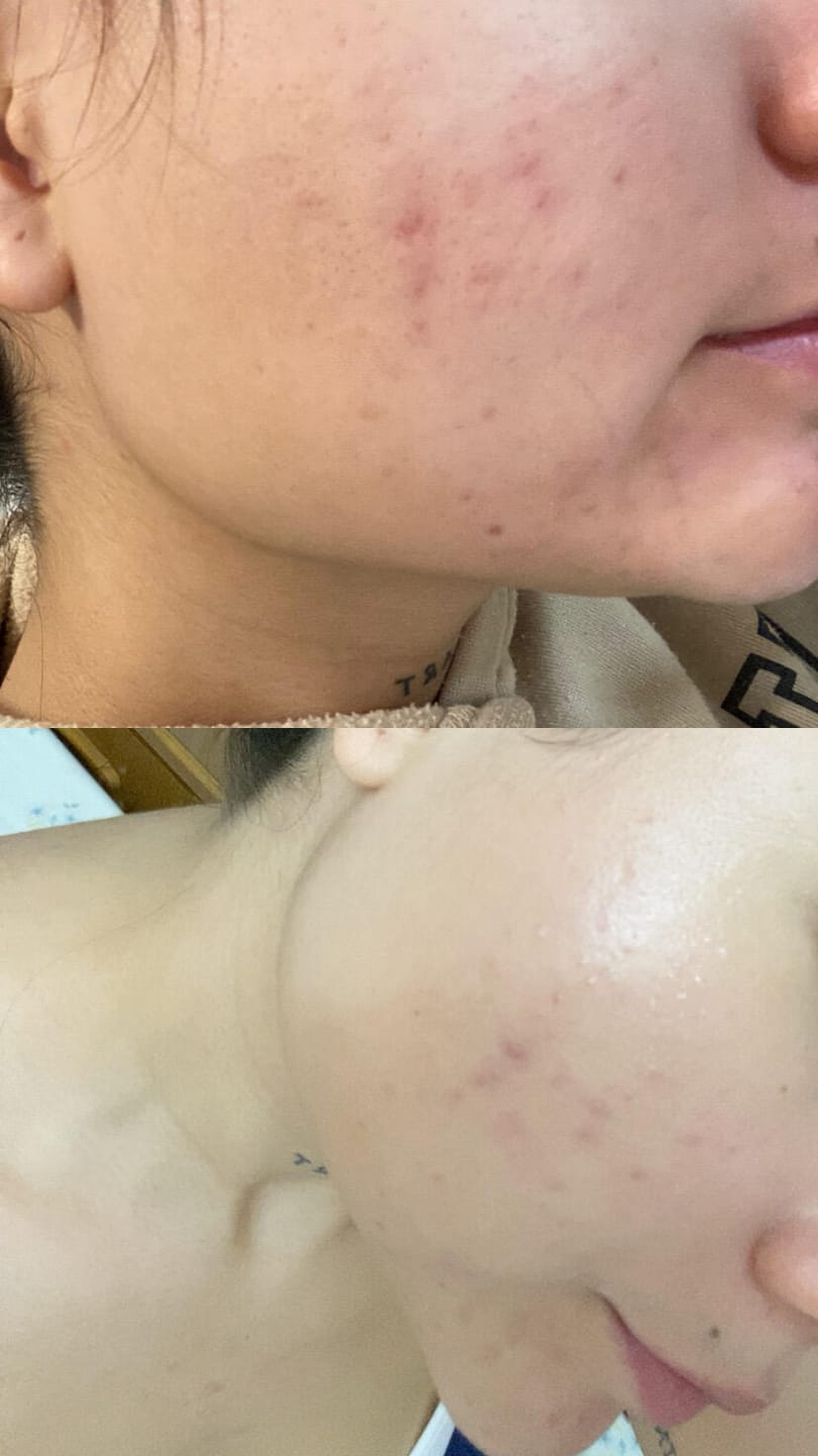 Customer photo review of MIRACLE H -  ÁCIDO HIPOCLOROSO - TÓNICO ANTIBACTERIANO Y ANTIINFLAMATORIO