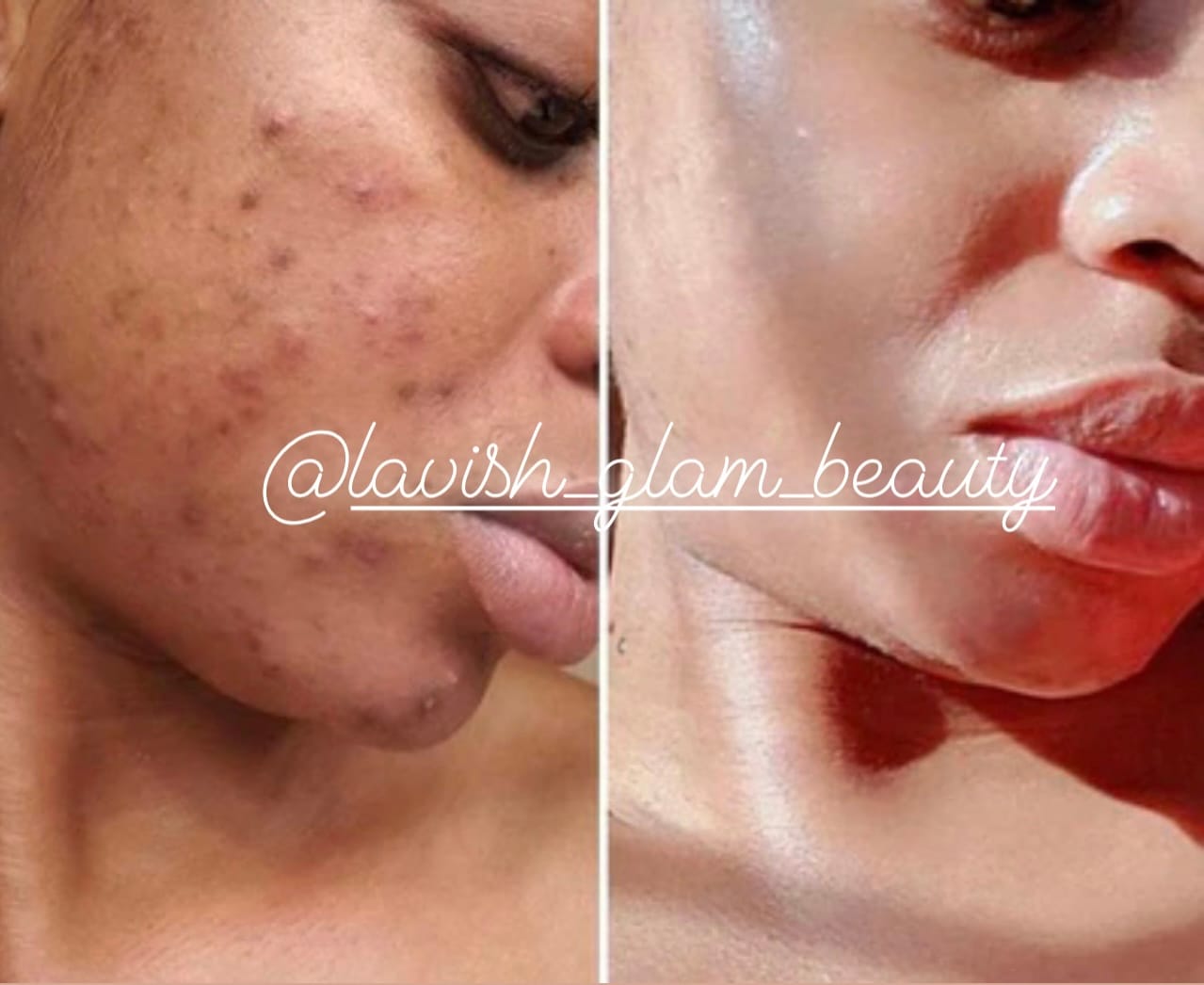 Customer photo review of 24k Golden Glow Essential Acne Kit