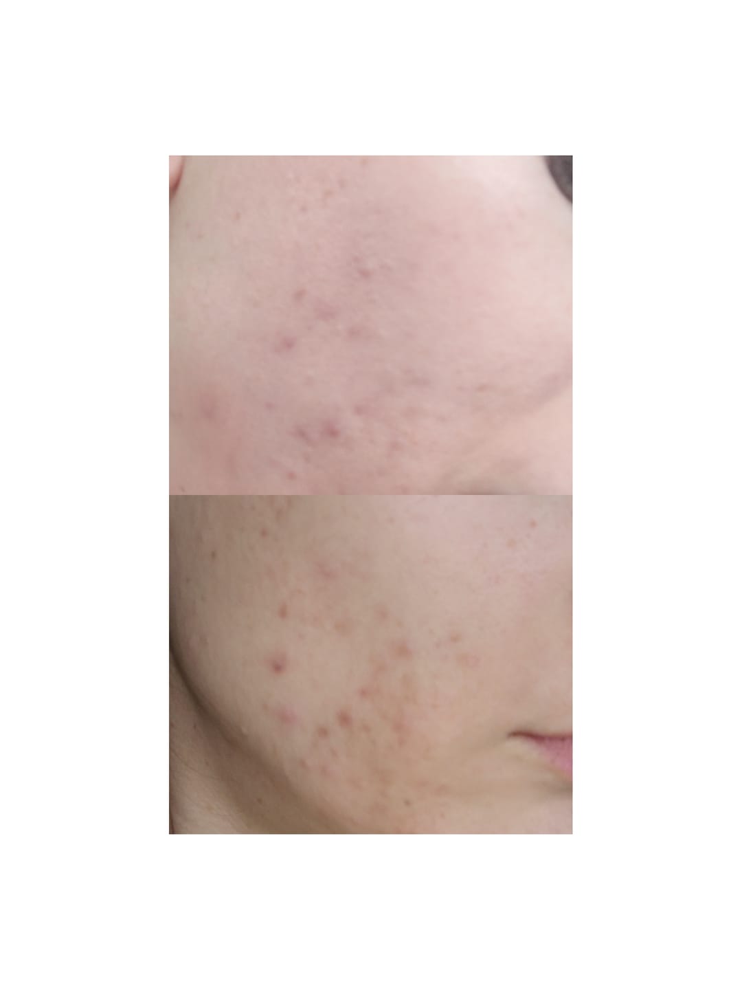 Customer photo review of Dr. Tisha AC7 Анти акне серум с микроигли