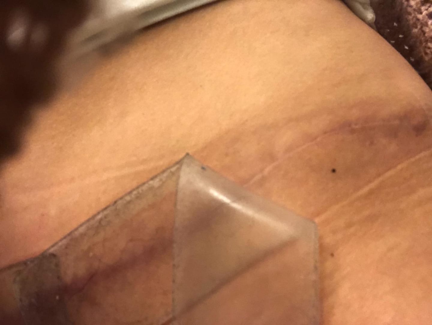 Customer photo review of Epi-Derm C-Strip