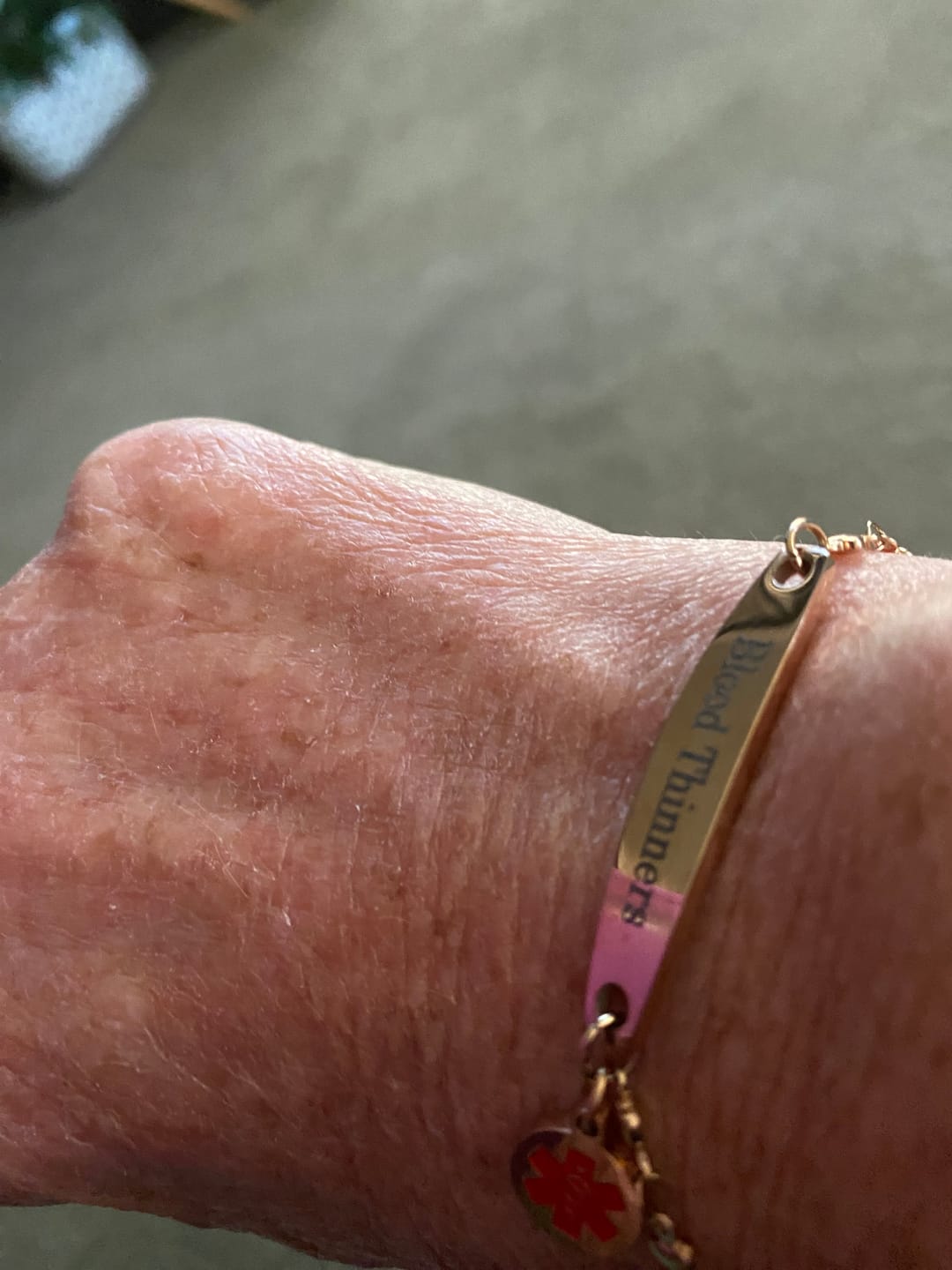 Customer photo review of Personalised Medical Alert Heart Link Bracelet - Gold Colour