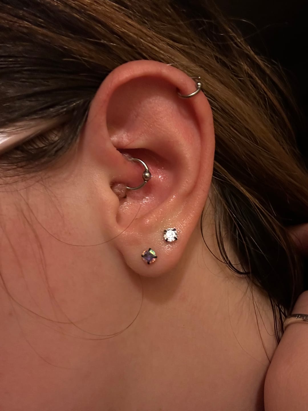 Customer photo review of Piercing Bump Treatment - Bump, Keloid & Scar Relief Oil