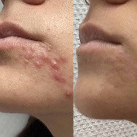 Customer photo review of Patchs anti boutons et acné