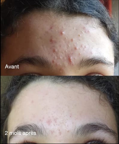 Customer photo review of Patchs anti boutons et acné
