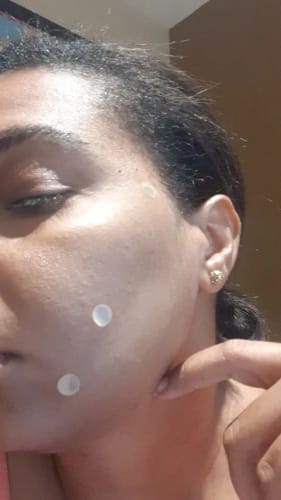 Customer photo review of Patchs anti boutons et acné