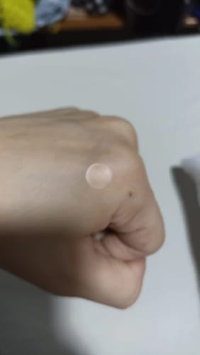 Customer photo review of Patchs anti boutons et acné