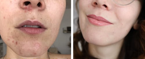 Customer photo review of Patchs anti boutons et acné