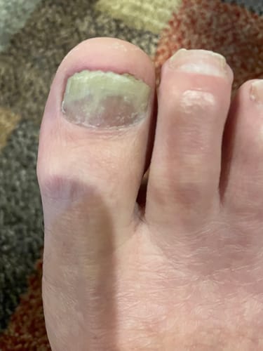 Customer photo review of Pentachom Antifungal Laser Program