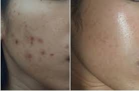 Customer photo review of Patchs anti boutons et acné