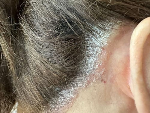 Customer photo review of ערכה דו שלבית לטיפול בקשקשים, קרקפת מגרדת ויבשה | SEBO DANDRUFF KIT