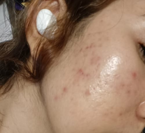 Customer photo review of Differin Gel Adapalene Gel 0.1% Acne Treatment 15g