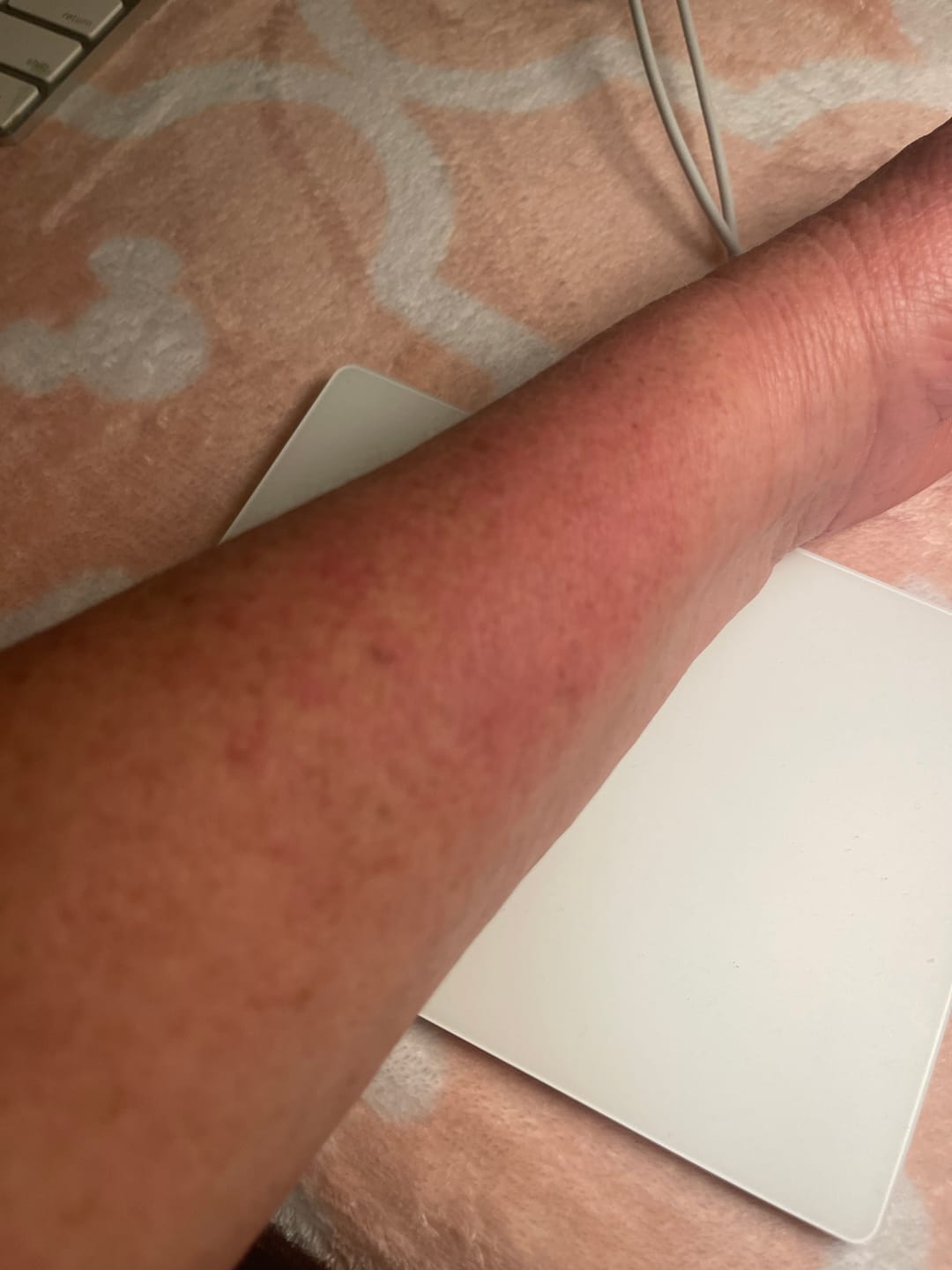 Customer photo review of Psoriasis Honey Skin-Renewing Cream