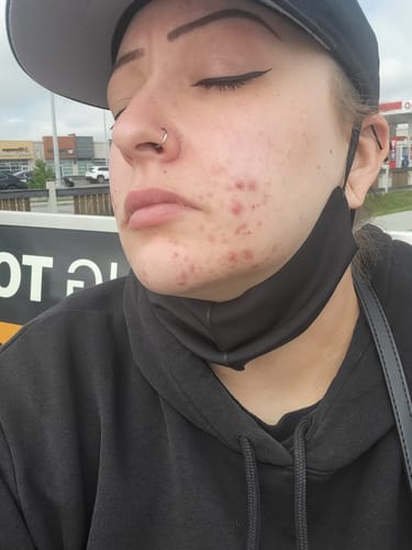 Customer photo review of SkinMedica AHA/BHA Exfoliating Cleanser