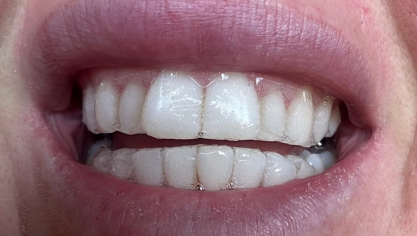 Customer photo review of Teeth Whitening Strips