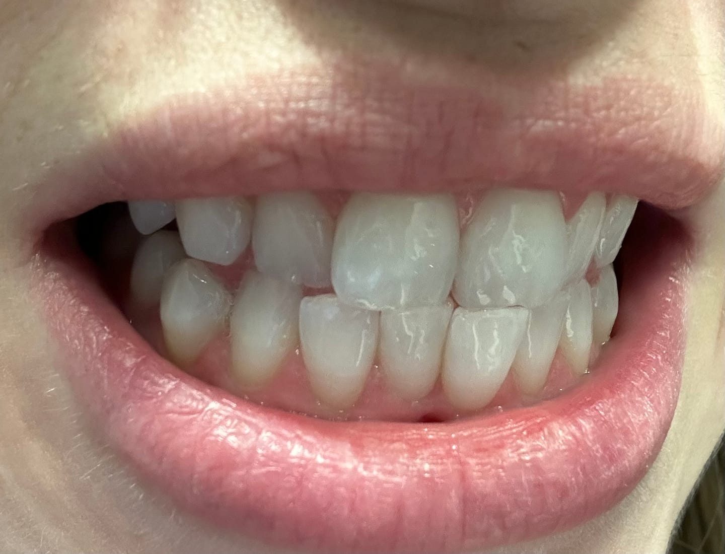 Customer photo review of Bandes Blanchissantes Kauka Smile (sans peroxyde)
