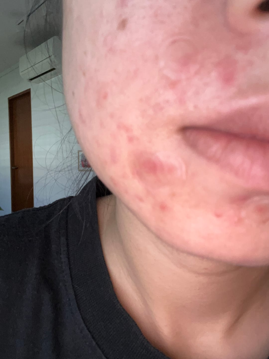 Customer photo review of Wonder Patch (acne patch)
