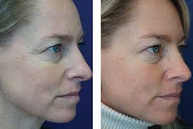 Customer photo review of Crème Anti Cernes et Rides Instantanée