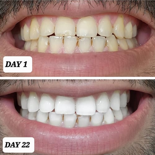 Customer photo review of Polar MD Teeth Whitening Kit