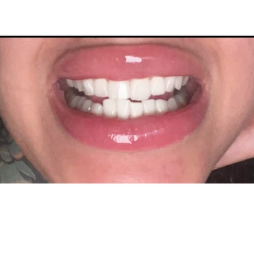 Customer photo review of Polar MD Teeth Whitening Kit