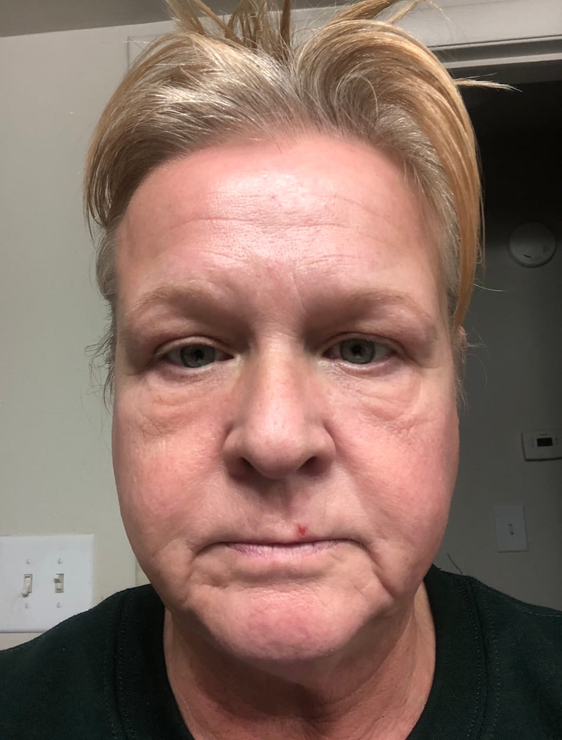 Customer photo review of 💛🔆💛 Skin Peel & Growth Factor Serum Duo 🌿